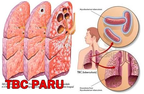 1.784 Warga Bojonegoro Terkena TB di 2017